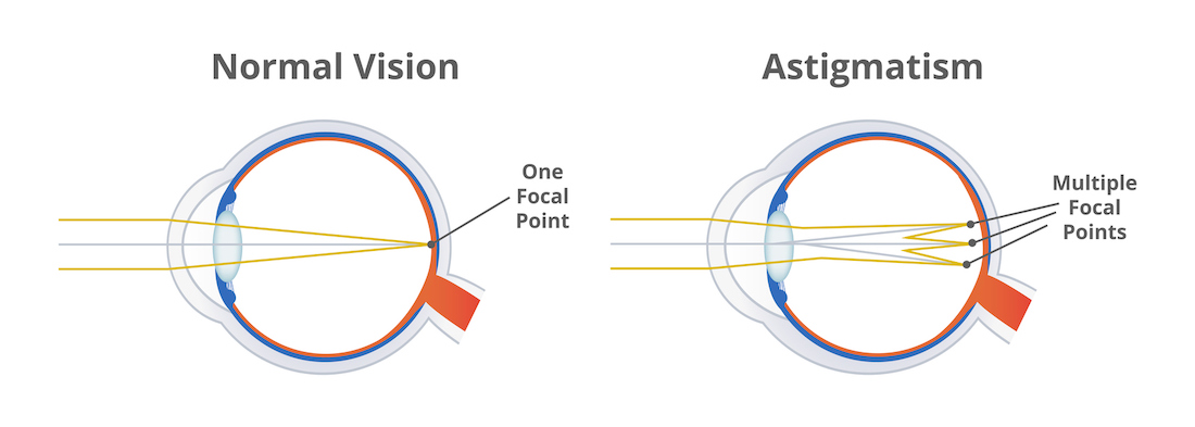 Astigmatism, refractive error, eye disorder, icon isolated on white. Blurred or distorted vision. stock illustration