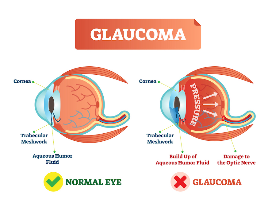 Vector illustration of glaucoma illness. Cross section comparement with normal and damaged eye. Scheme with cornea, trabecular meshwork and aqueous humor fluid.