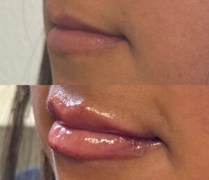 lip filler enhancement before and after - profile view