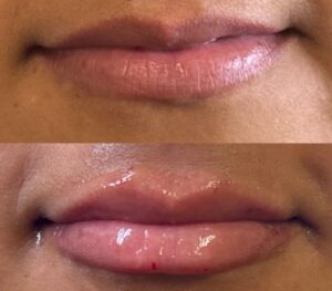 lip filler enhancement before and after - front view