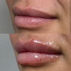 lip filler before and after