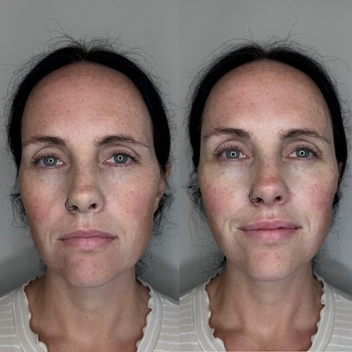 A woman's cheeks before and after Sculptra and after and after