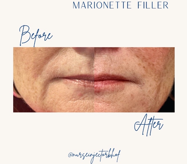 Before and after filler - marionette lines