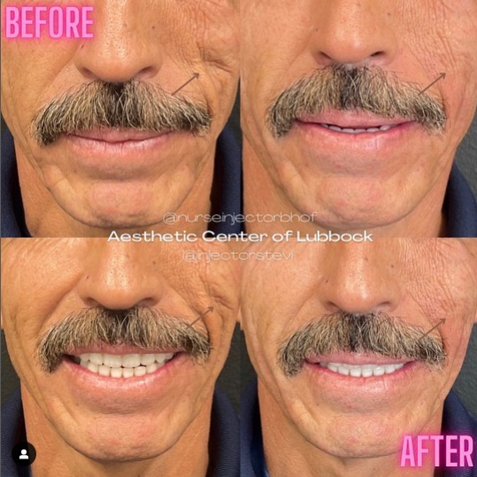 Before and after of man receiving filler to create more symmetry