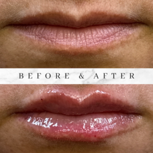 lips before and after