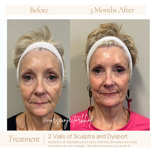 Before and after image of woman 3 months after two vials of Sculptra and Dysport
