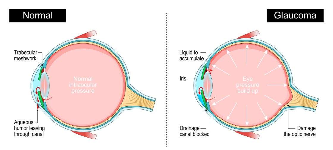 Glaucoma. Cross section of a Human eye stock illustration